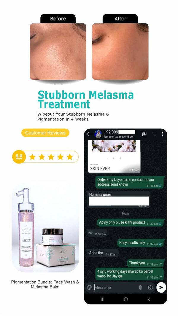 Face Balm For Melasma